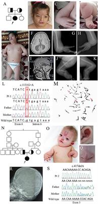 Phenotypic Overlap of Roberts and Baller-Gerold Syndromes in Two Patients With Craniosynostosis, Limb Reductions, and ESCO2 Mutations